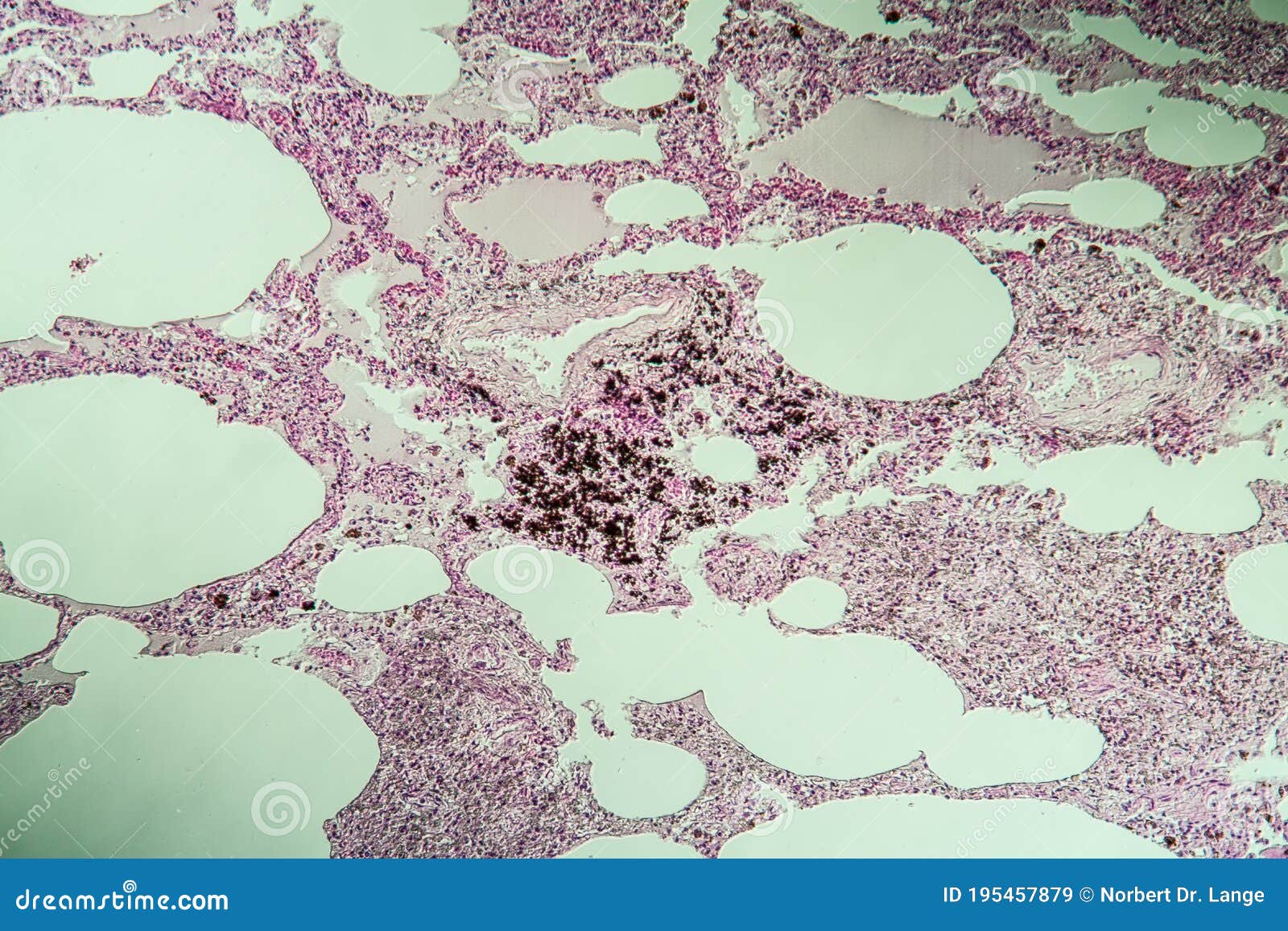 Lung Tissue As Dust Lung Under the Microscope Stock Image Image of