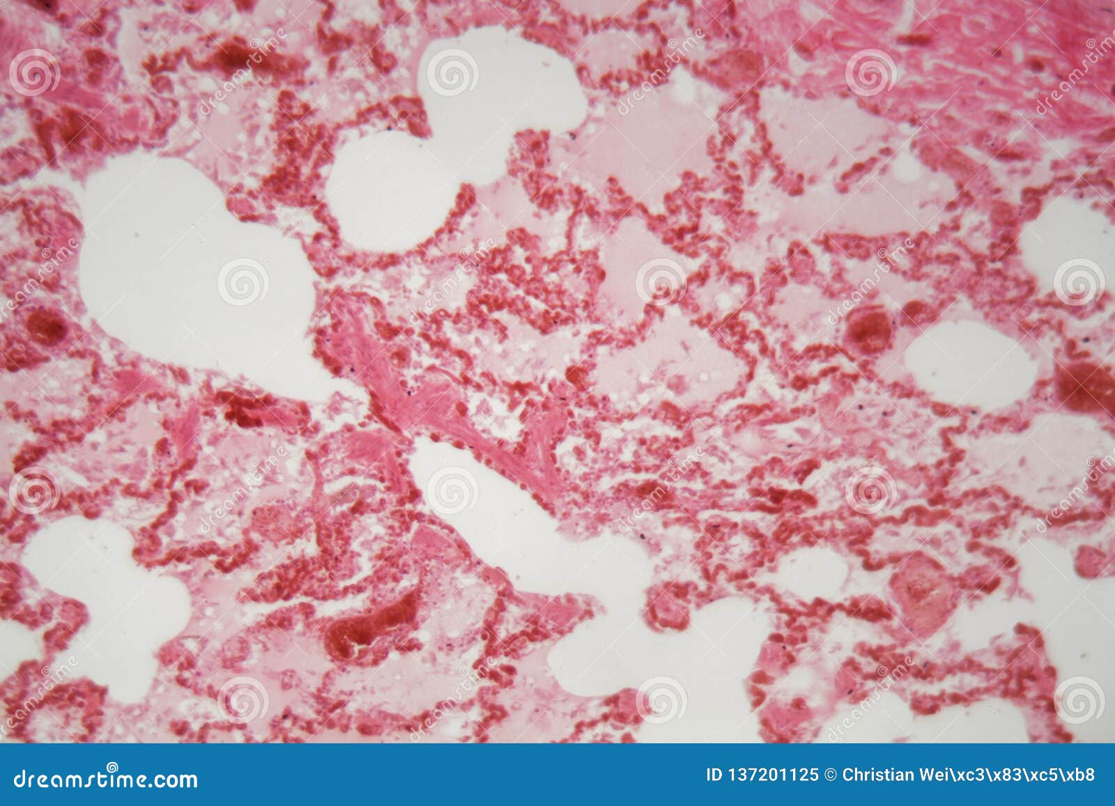 Lung Tissue with Pneumonia Infection Caused by Flu Viral Pneumonia