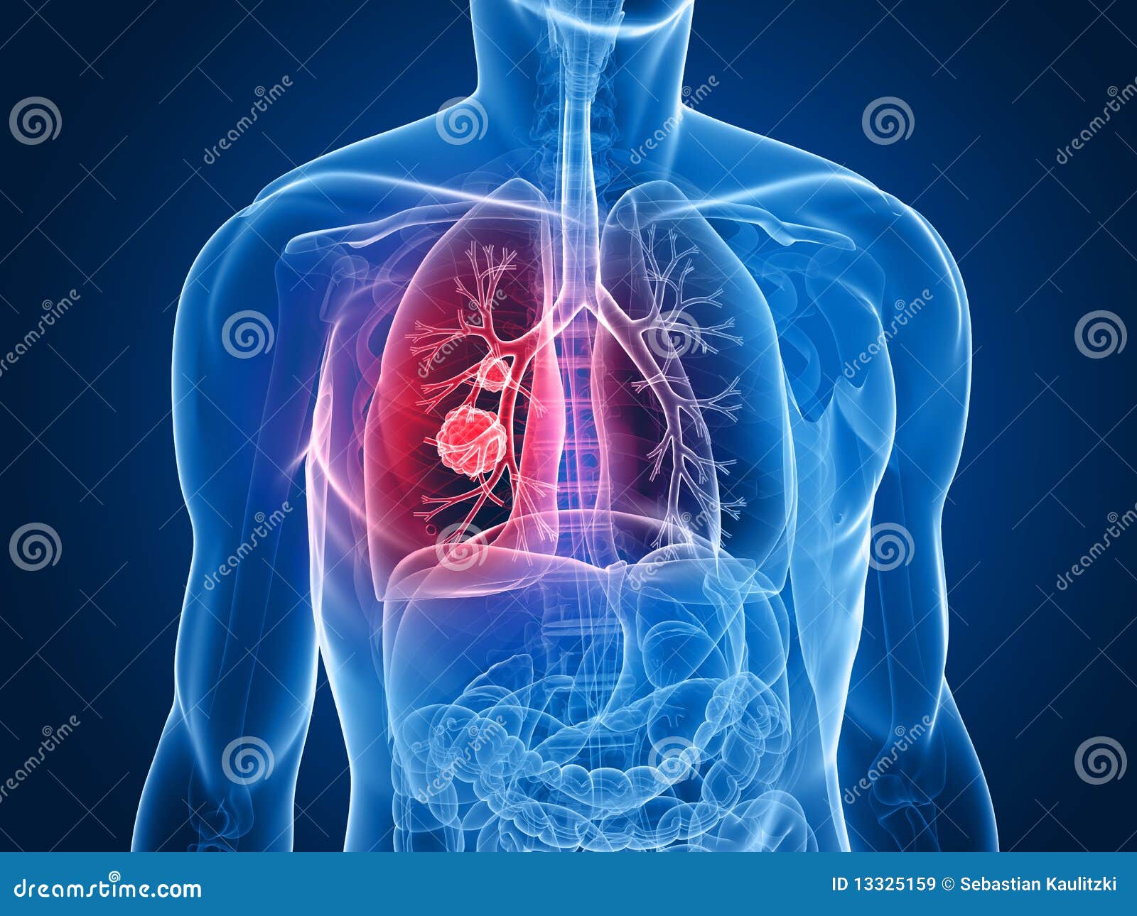 lung tumor