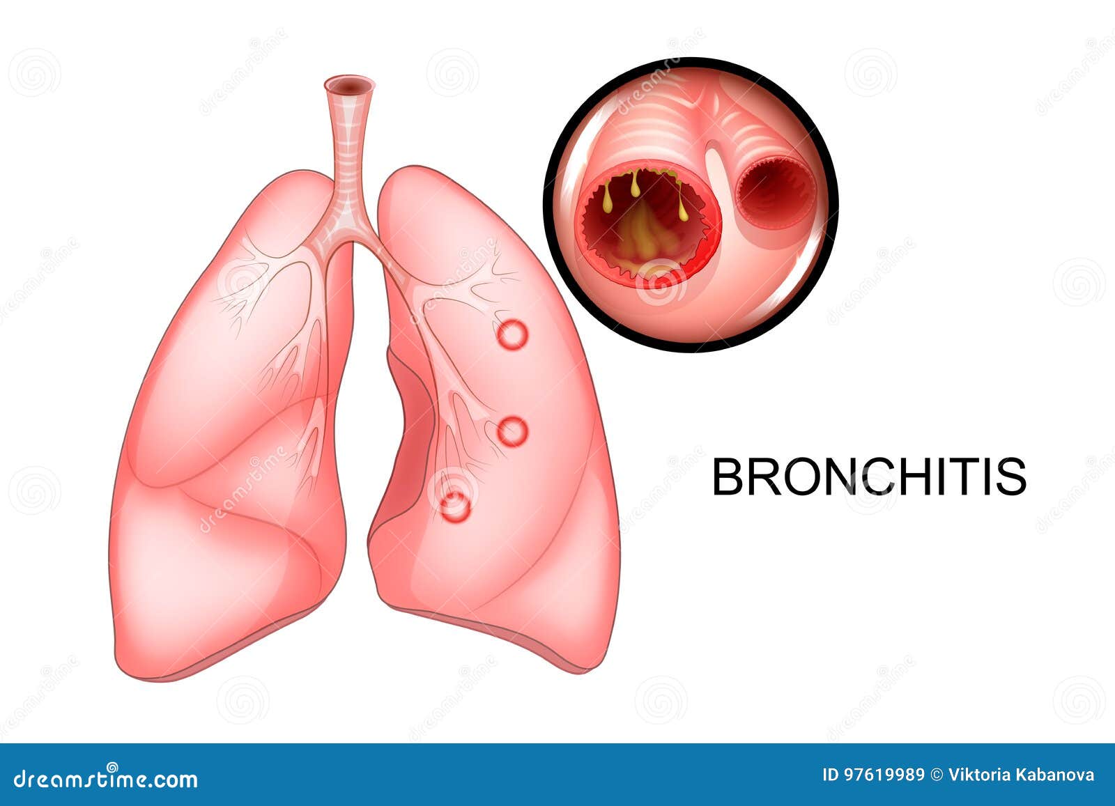 the lungs, affected with bronchitis