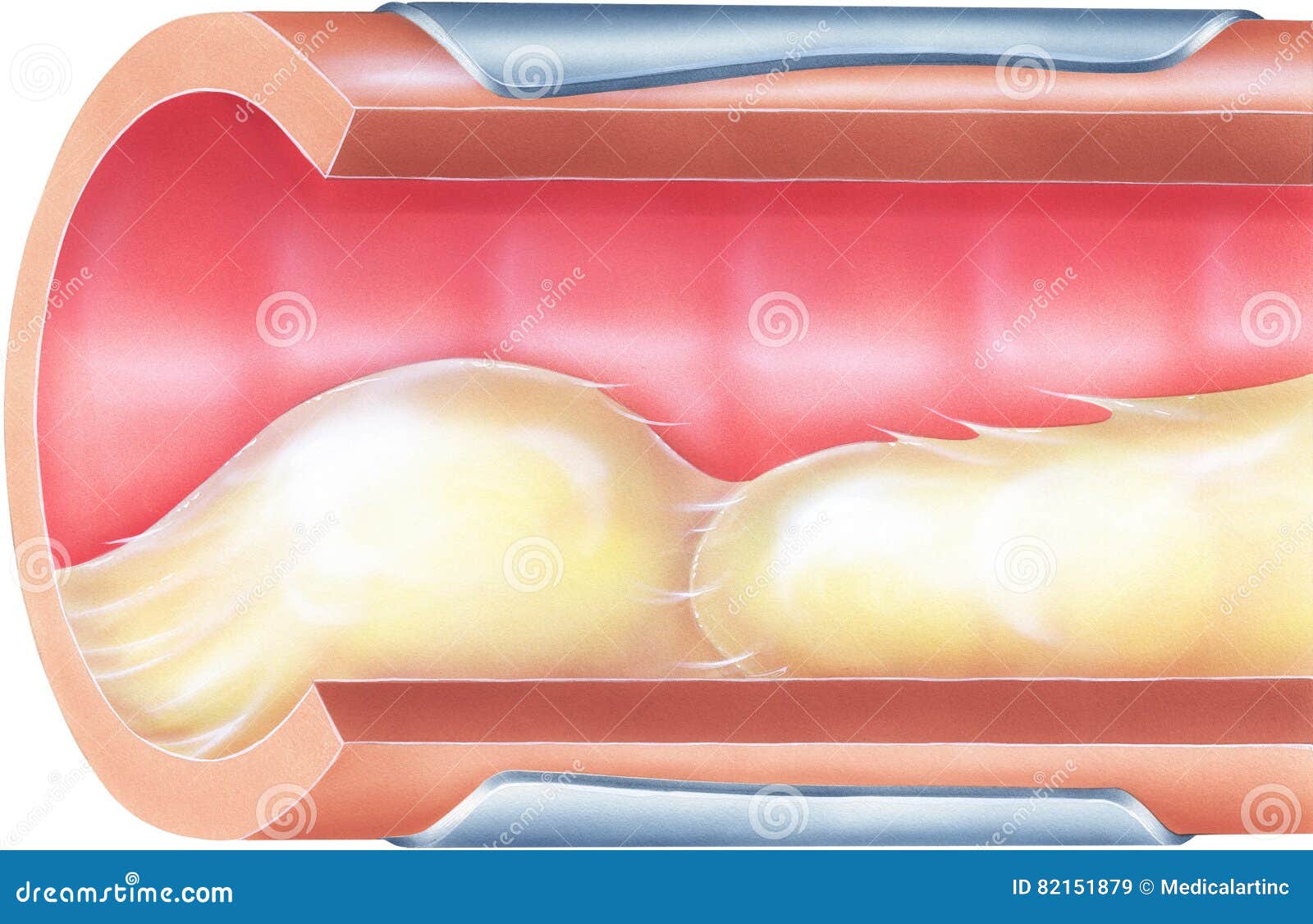 lungs - bronchial mucus causing airway obstruction