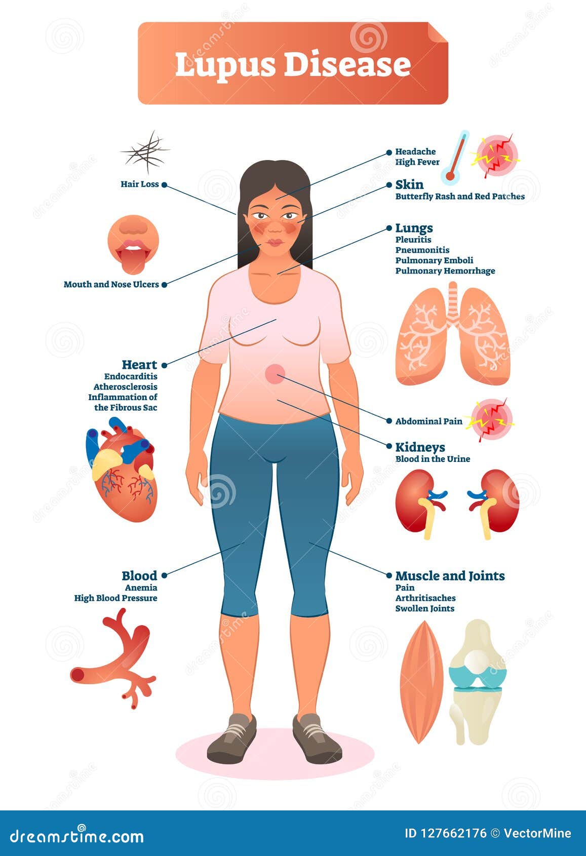 Lupus - Systemic Lupus Erythematosus (SLE) - Causes, Sign & Symptoms