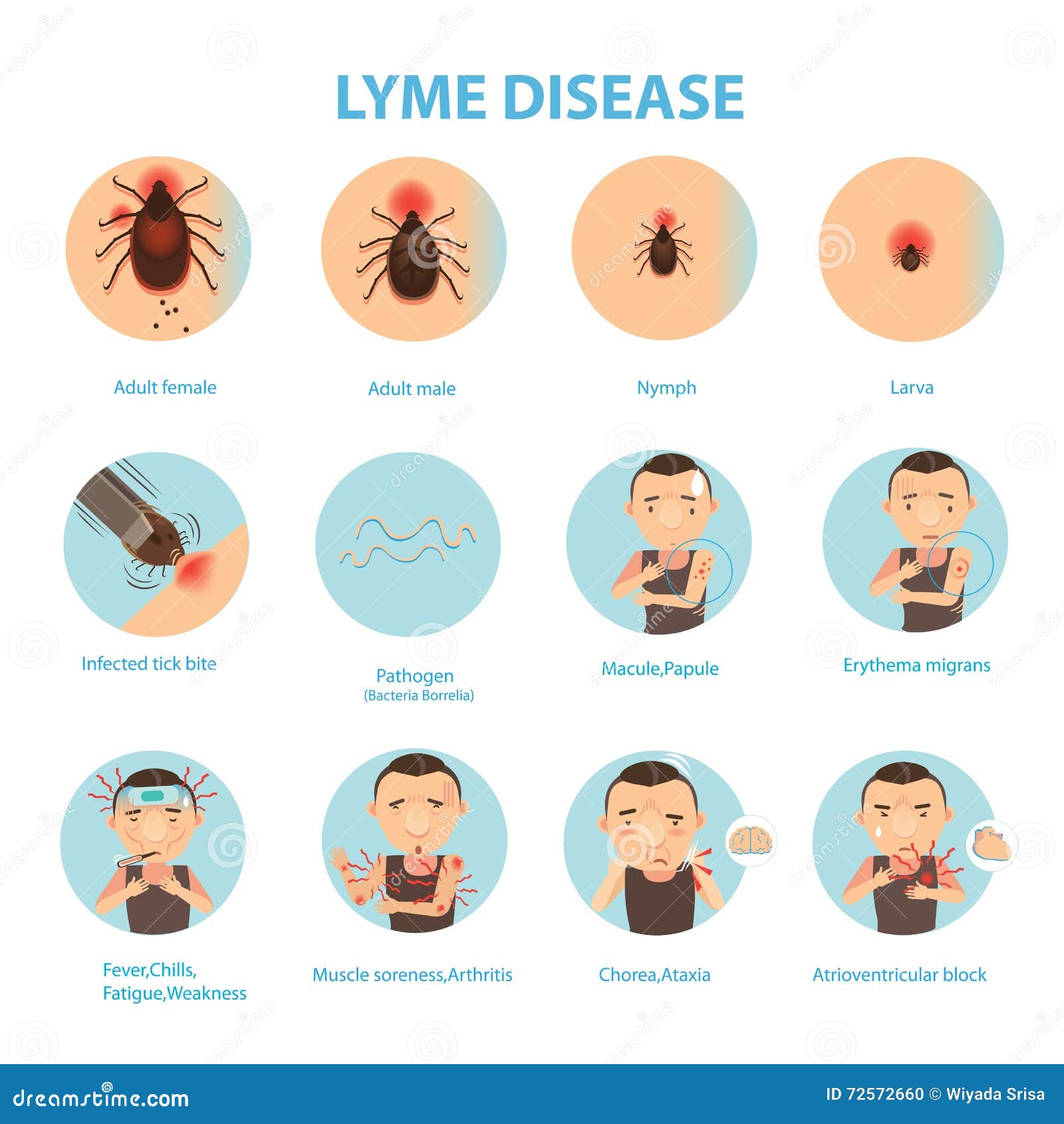 LymeBorreliose vektor abbildung. Illustration von endemisch 72572660