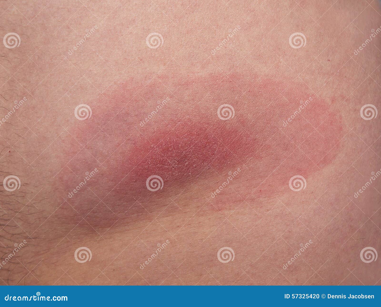 Lyme Borreliosis From A Tick Bite Stock Photo Image Of Area Tick