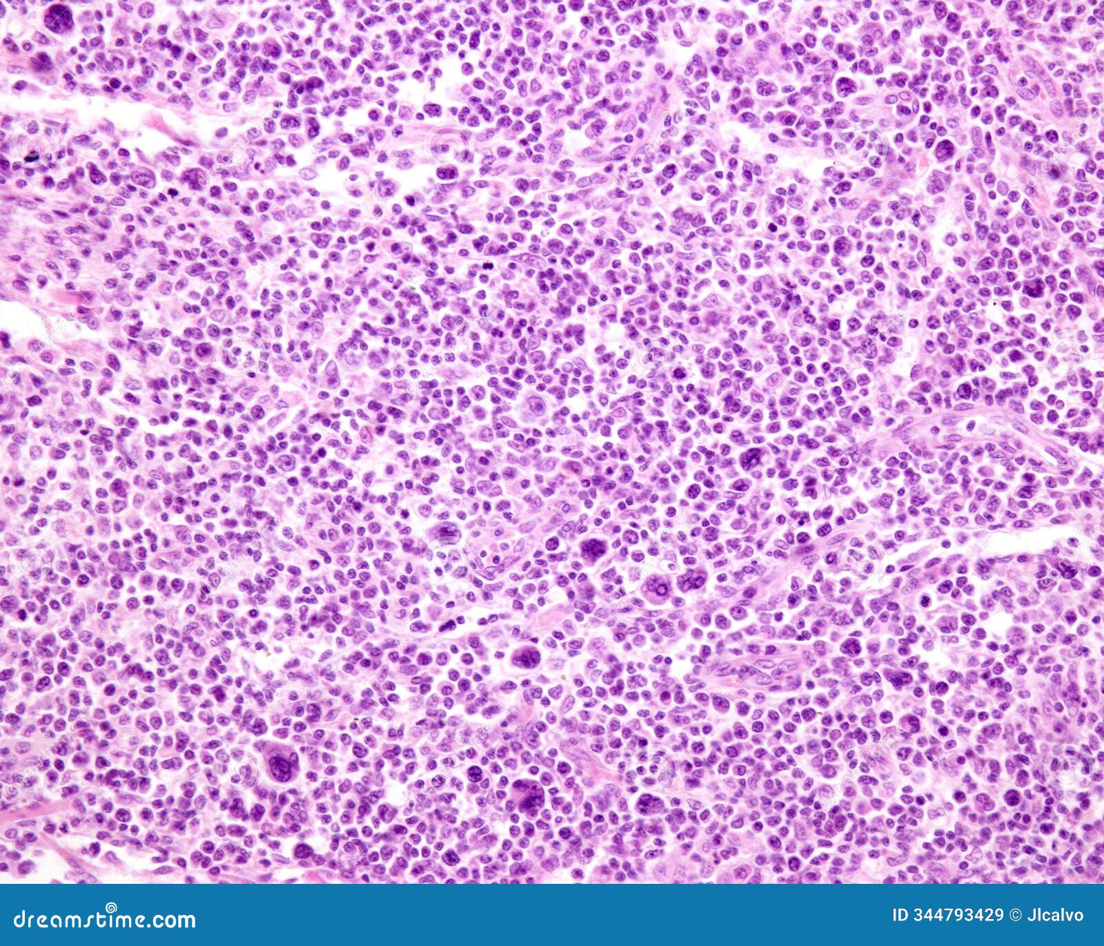lymph node. hodgkin lymphoma