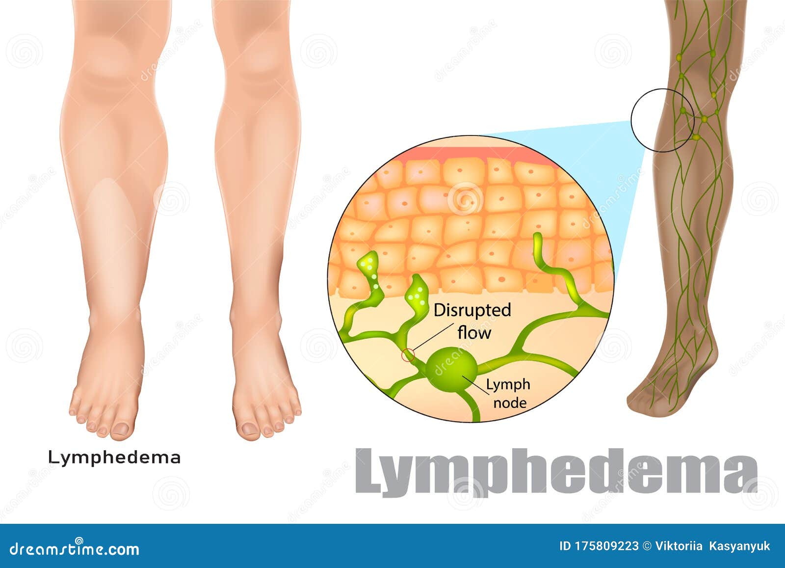 lymphedema, also known as lymphoedema