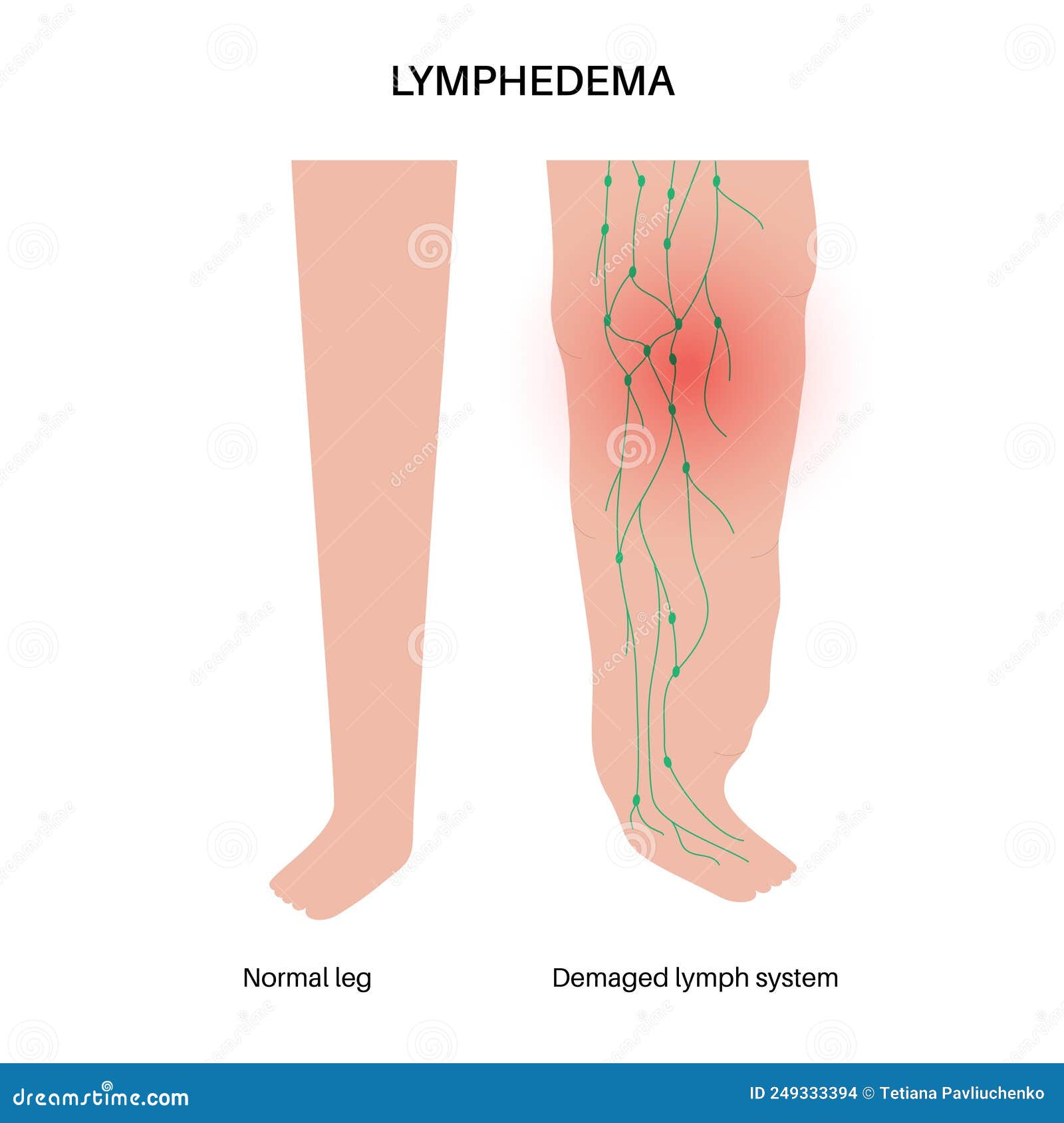 Lymphedema leg swelling stock vector. Illustration of lymphoedema ...