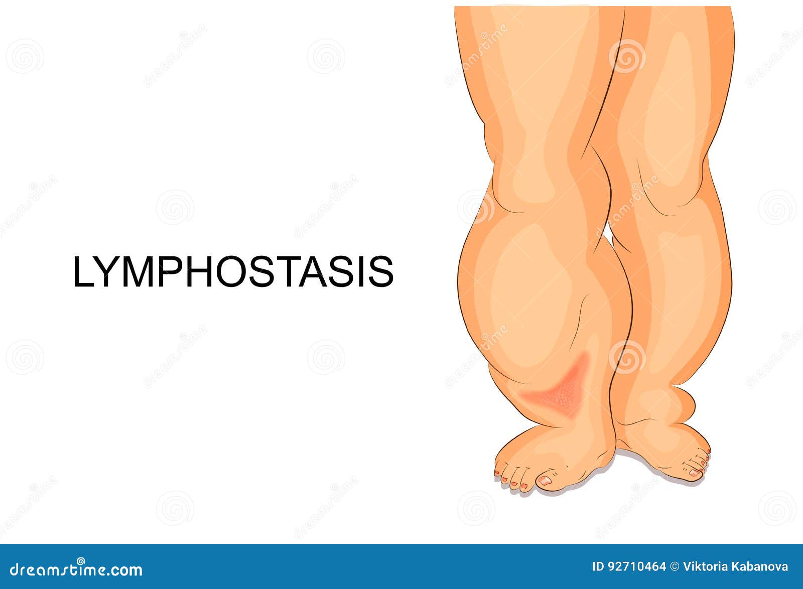 lymphostasis. lymph edema of the feet