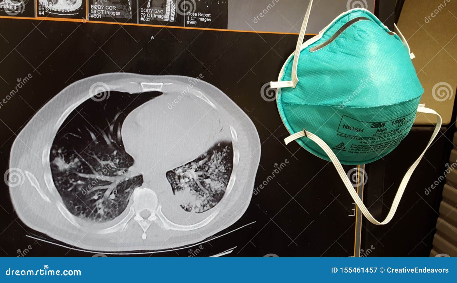 Mascara Respiratoria Del Aislamiento N 95 Con El Pecho Ct Que Muestra Pulmonia De La Tb Imagen De Archivo Imagen De Gotita Verde