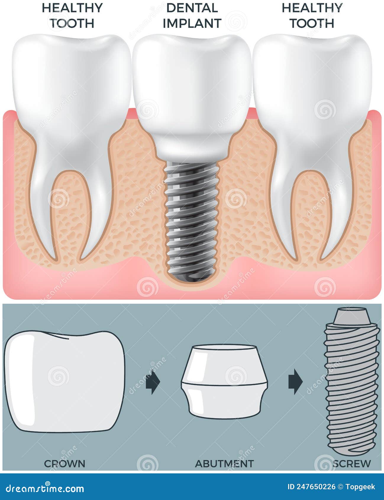 Mâchoire Humaine Avec Dents Saines Normales Et Prothèse Dans La