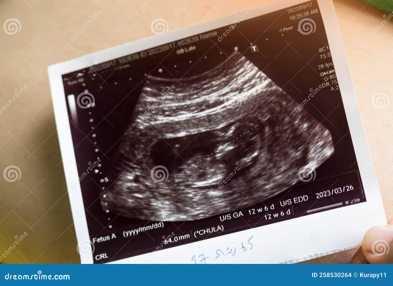une photo recadrée d'une femme enceinte après une échographie