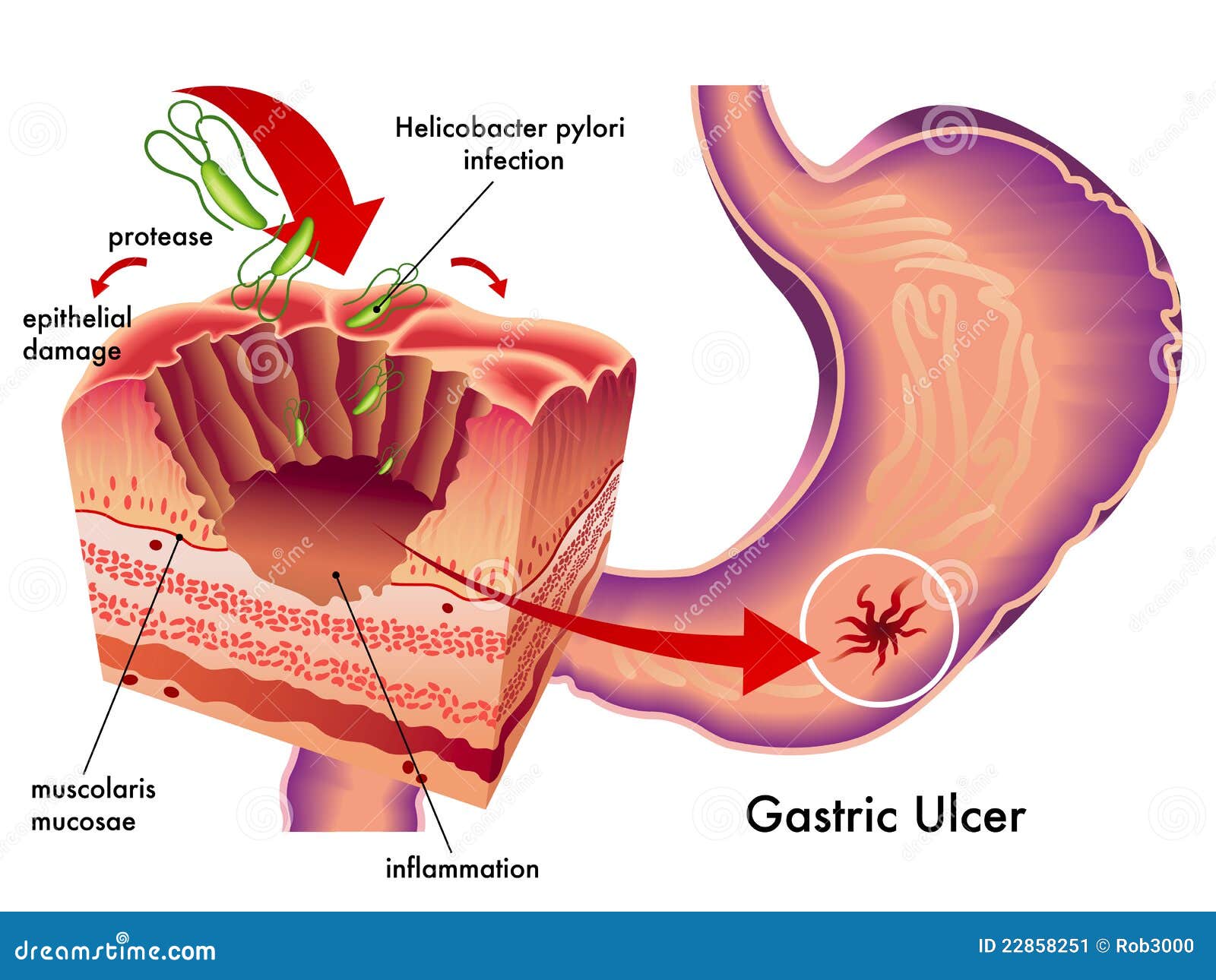 Gastritis después de erradicar helicobacter