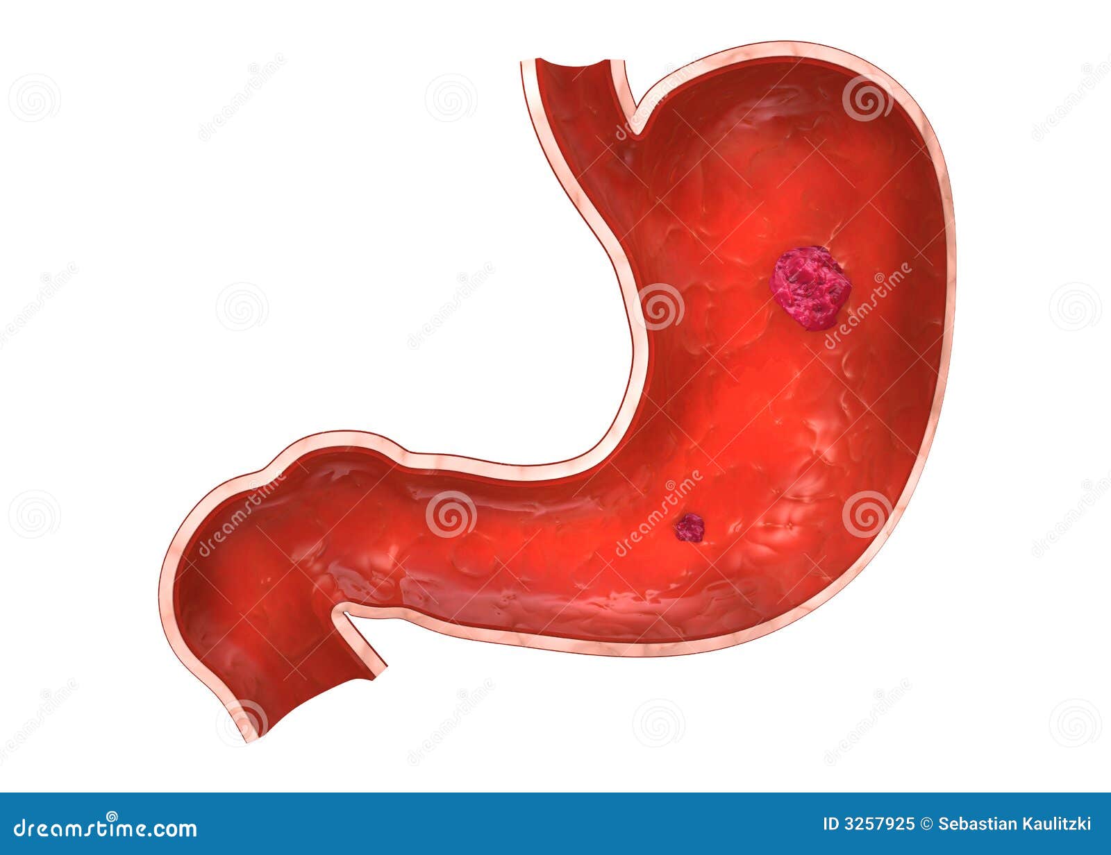 Maagzweer/tumor. 3d teruggegeven anatomieillustratie van een menselijke zieke maag