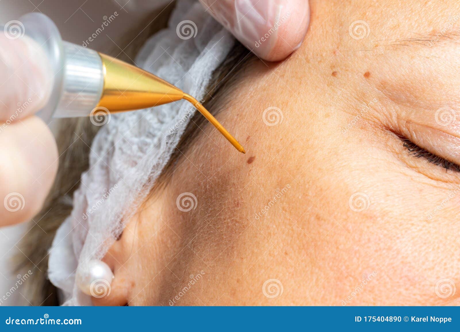 macro close up of laser plasma pen removing facial wart on middle aged woman