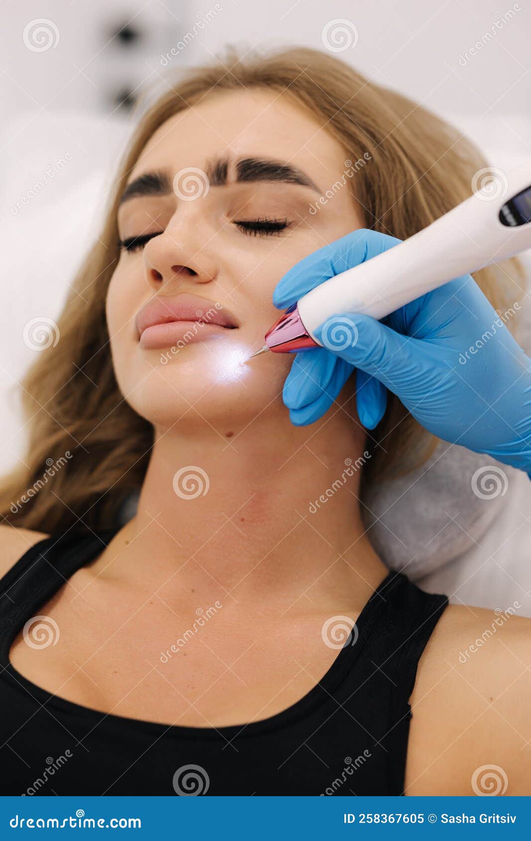 macro close up detail of laser plasma pen removing facial wart on young woman. noninvasive cosmetic treatment