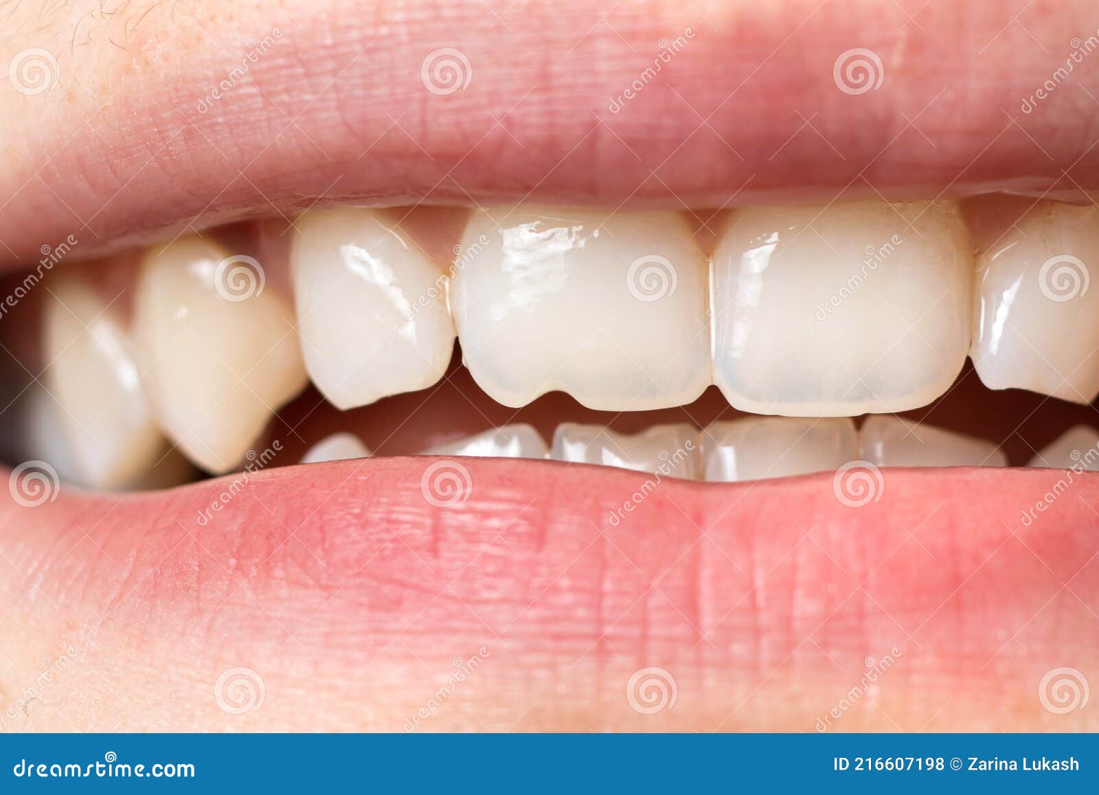 macro close-up of human teeth. shows the chipped tooth. the effect of the cutter's tooth from biting the seeds shell and