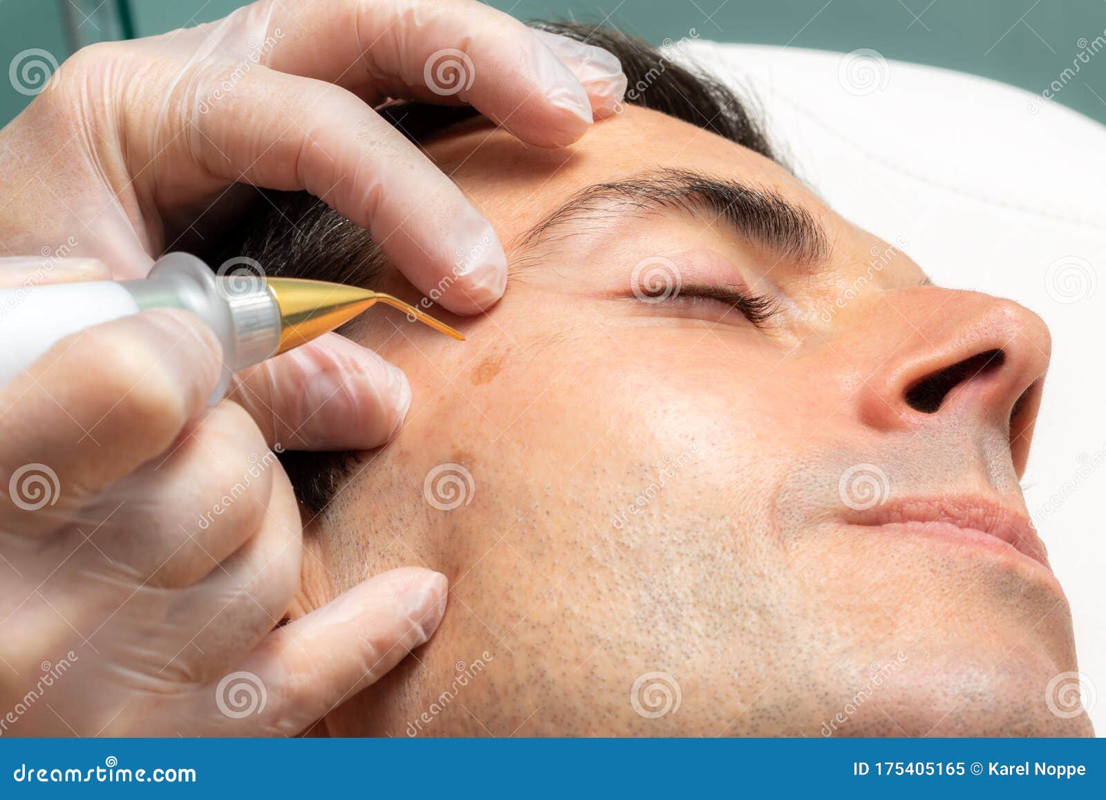 macro close up of laser plasma pen removing facial melanoma on middle aged man.