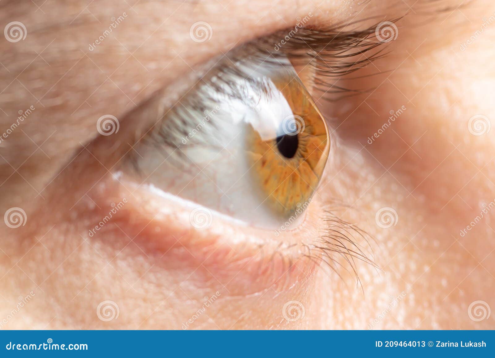 macro eye photo. keratoconus - eye disease, thinning of the cornea in the form of a cone. the cornea plastic. ophthalmology