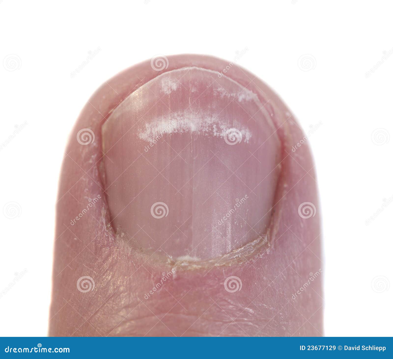 macro of a fingernail with leukonychia