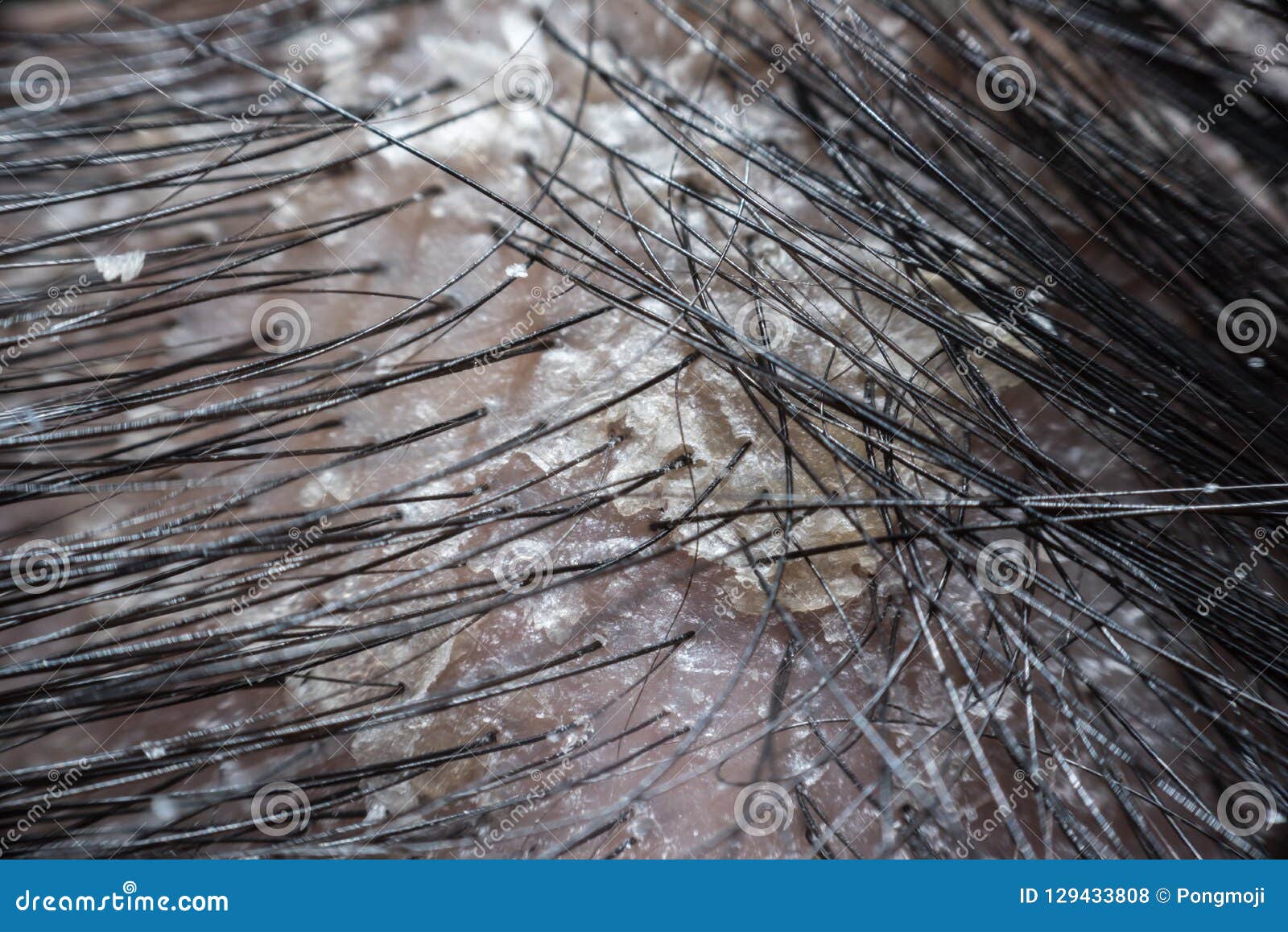 Hair Scalp with Dandruff and Scaly from Psoriasis Stock Photo - Image of  health, dandruff: 129433808