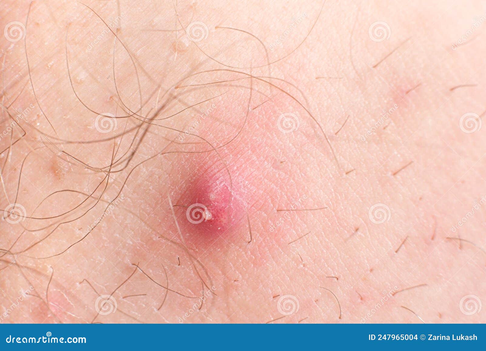 Postkort bronze Ligegyldighed Macro Photo of a Large Red Pimple with the Release of Pus on Human Skin  Stock Photo - Image of skincare, dermatology: 247965004