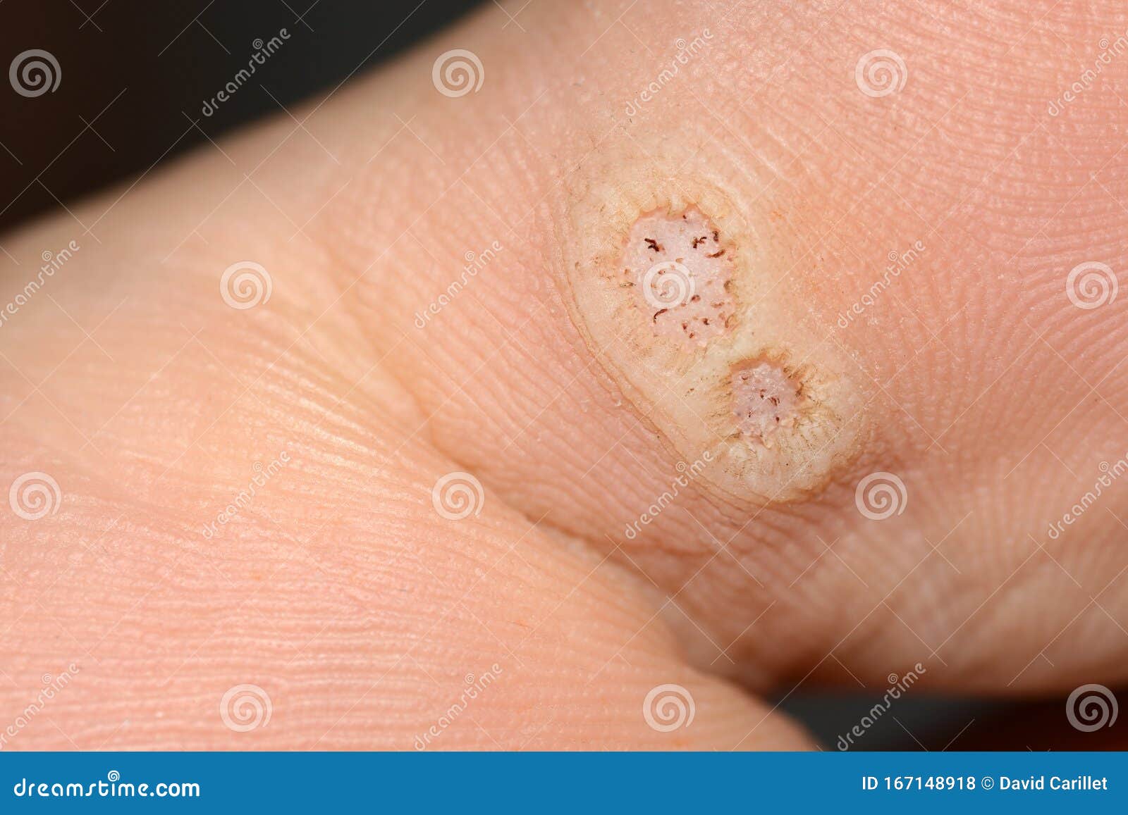 human papillomavirus feet)