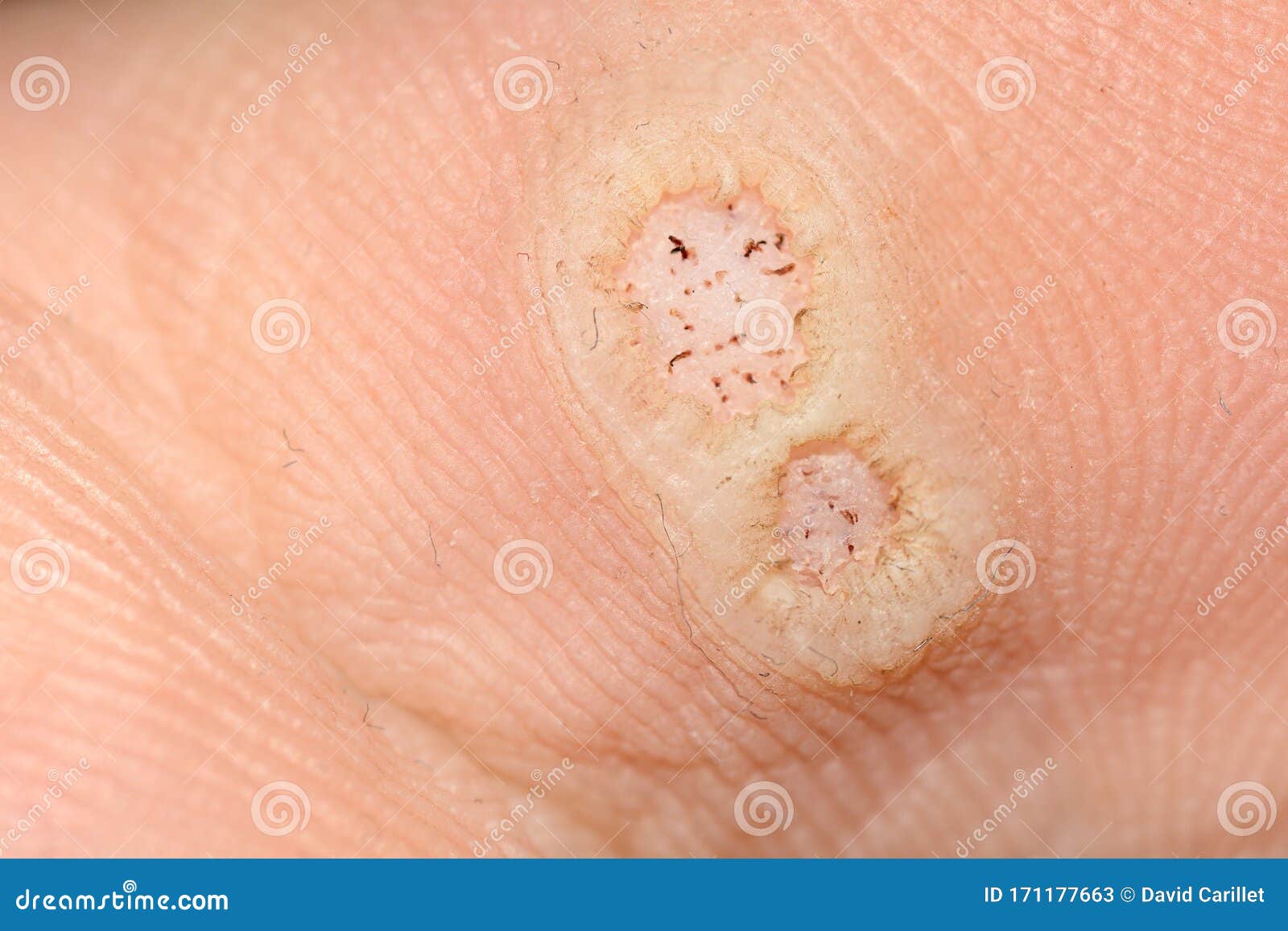 Papilloma genital warts