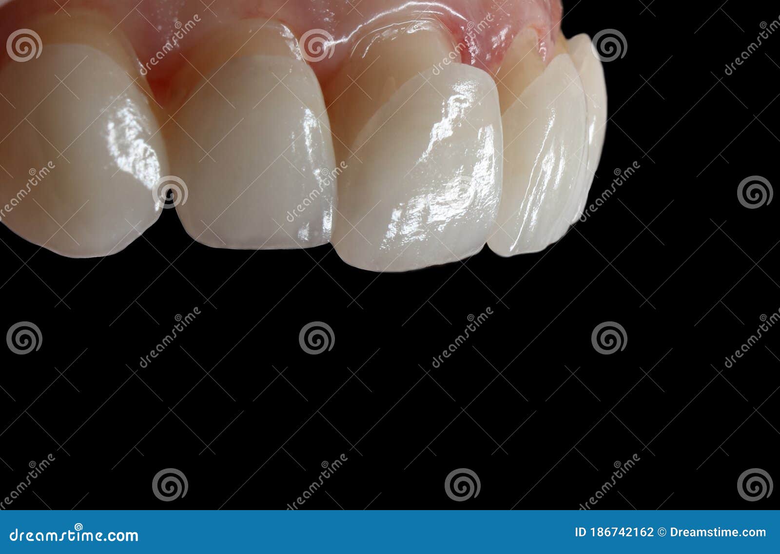 dental ceramic veneers on the black background