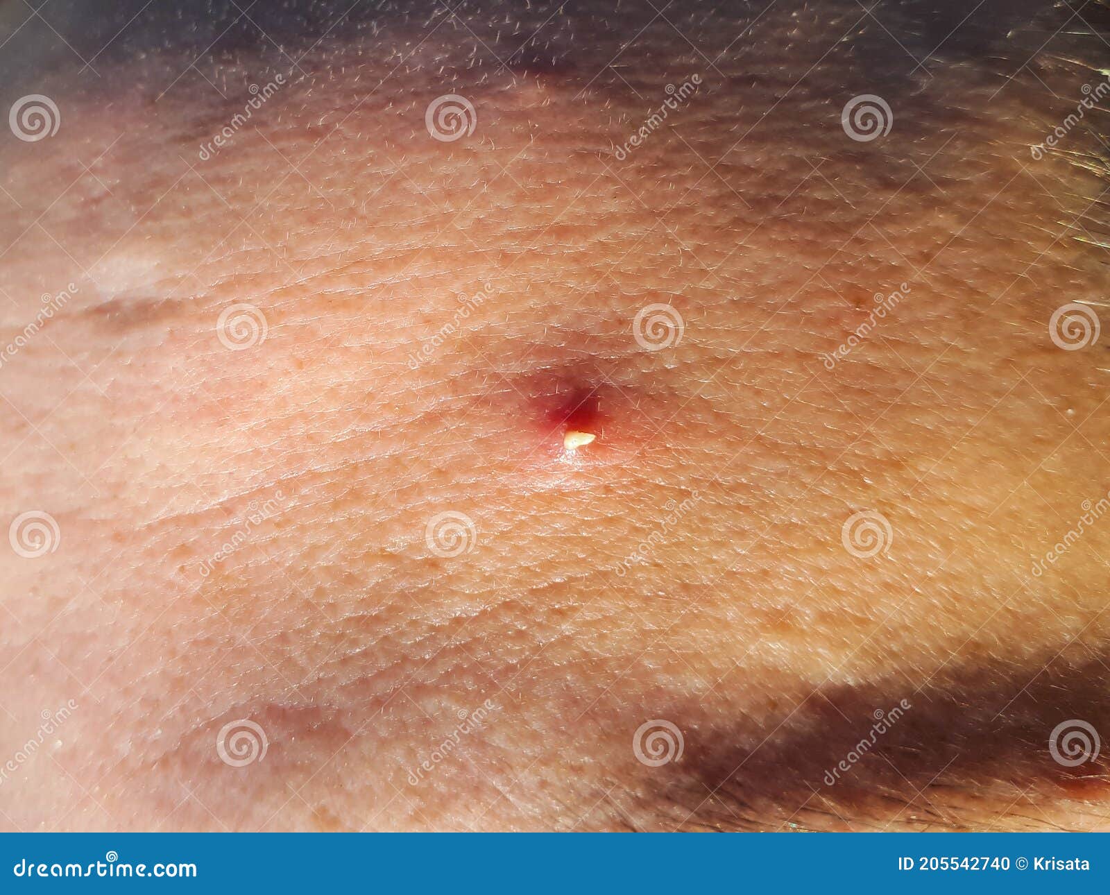 Smag Vittig høste Red Pimple with White Pus Squeezed Out on Tanned Mature Skin Stock Photo -  Image of adolescent, furuncle: 205542740