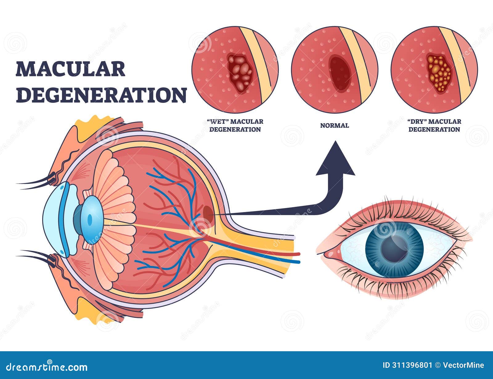 macular degeneration as eye illness and eyesight problem outline diagram