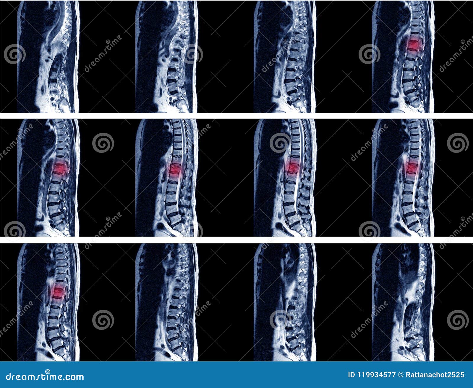 magnetic resonance image of human spine with lordosis,moderate compressiom fracture of t12