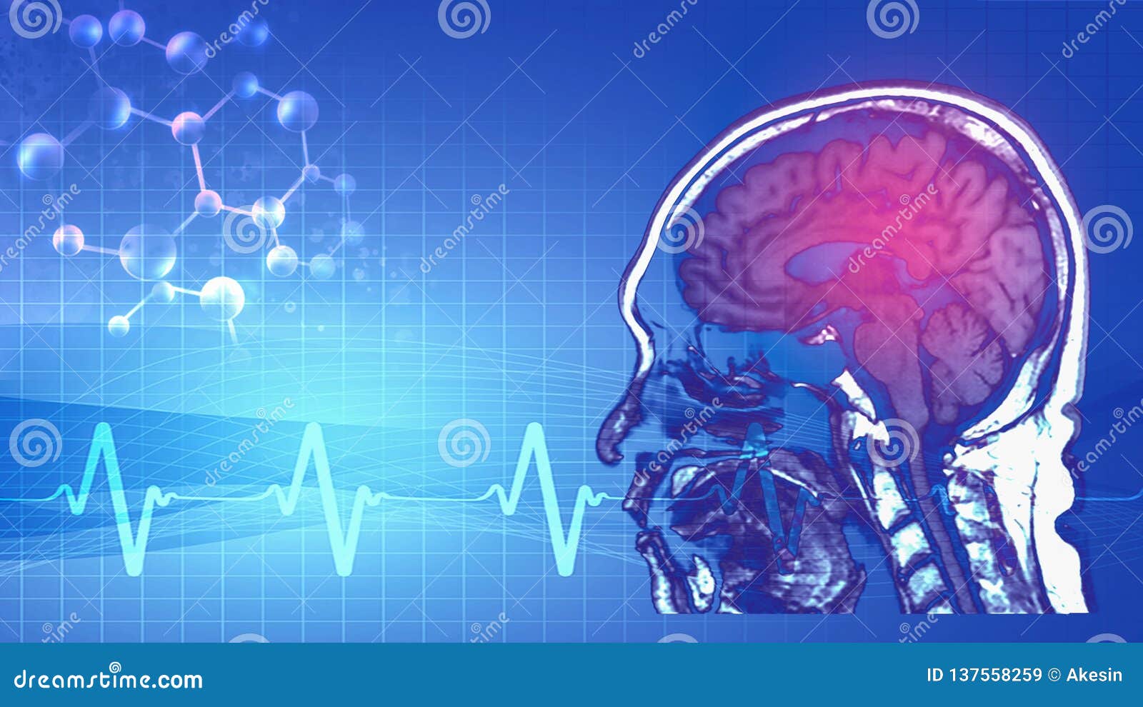 Magnetic Resonance Image MRI of Brain Stock Illustration - Illustration ...