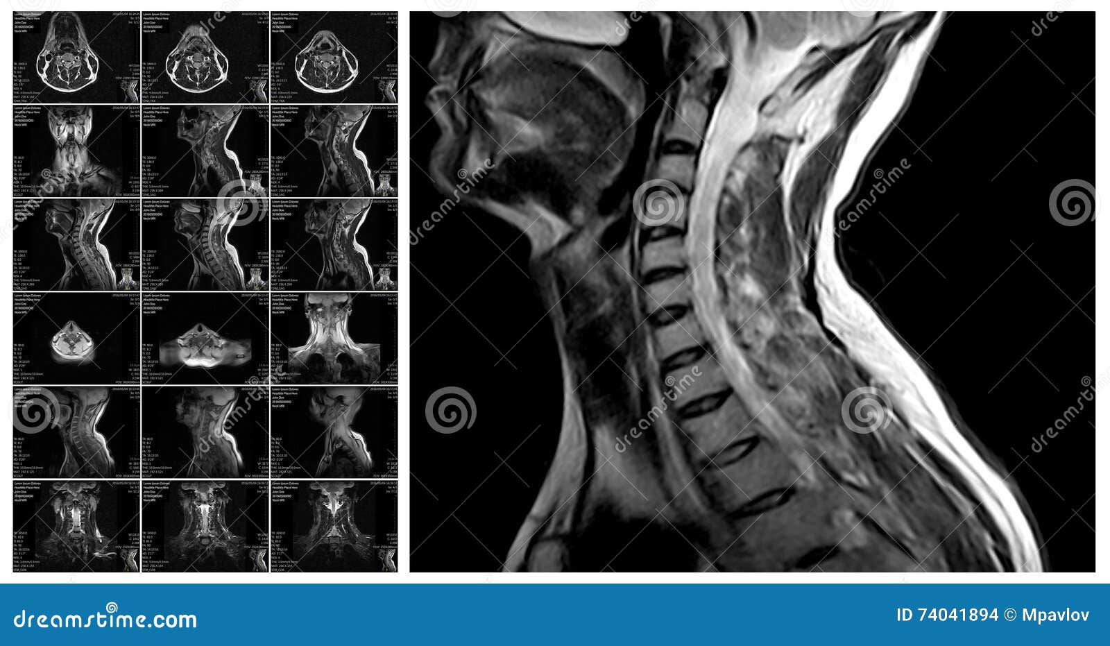magnetic resonance imaging of the cervical spine.