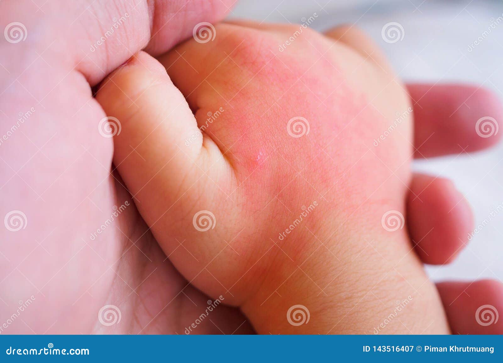 Main De Bebe Avec L Eruption Cutanee Et L Allergie Avec La Tache Rouge Image Stock Image Du Infection Dermatite Main De Bebe Avec L Eruption Cutanee Et L Allergie Avec La Tache Rouge Image Stock Image Du Infection Dermatite