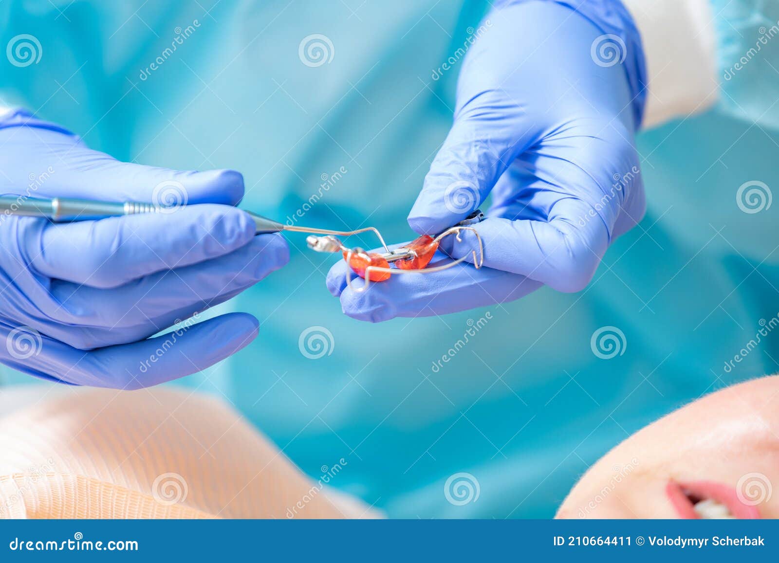 Making Cast of the Upper Row of Teeth Using a Special Plate and Soft