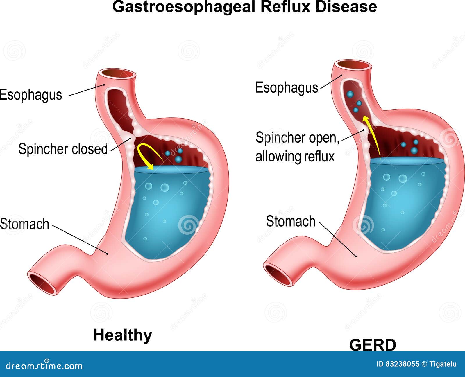 Malattia Da Reflusso Gastroesofageo Illustrazione Vettoriale