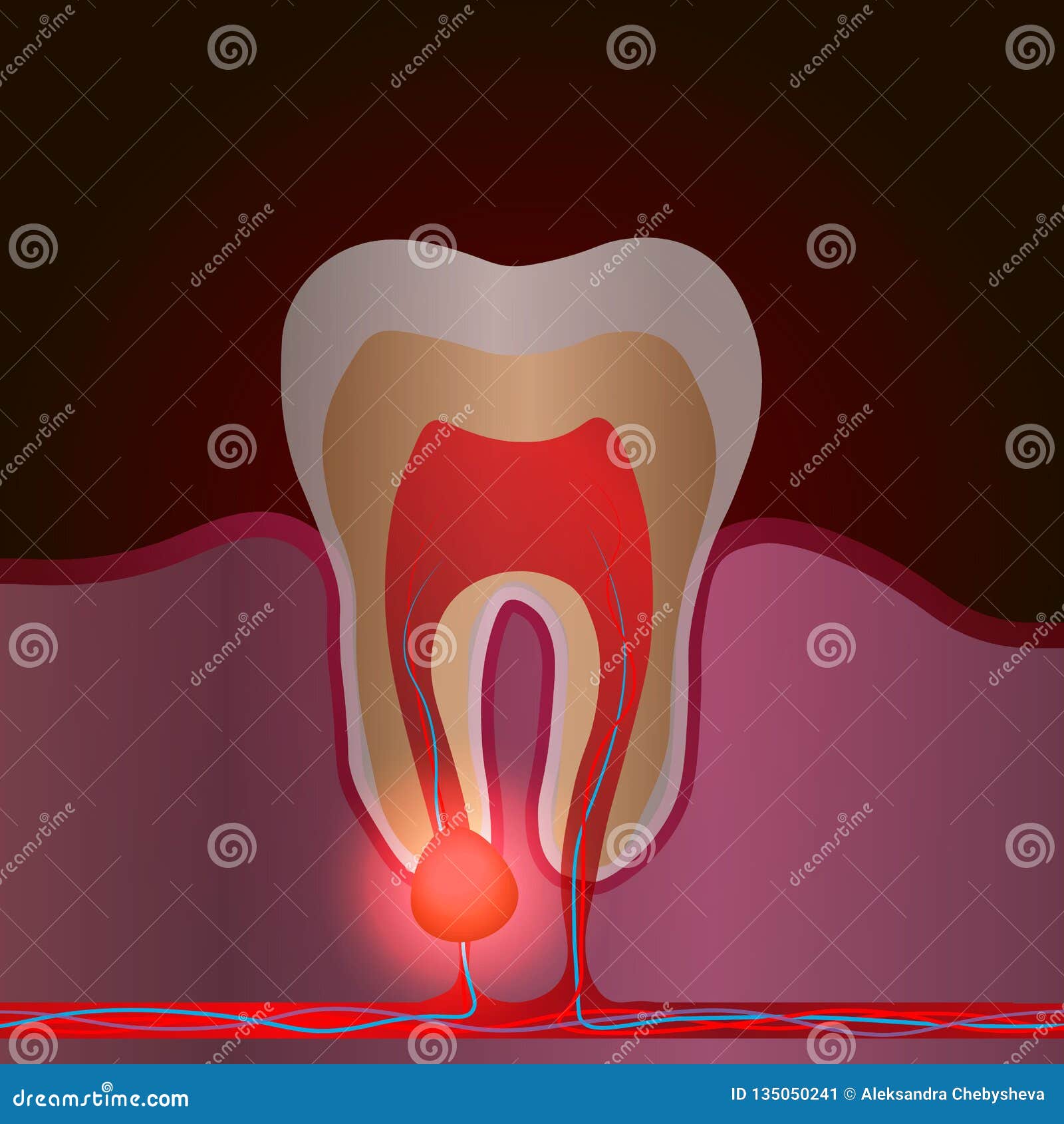 Radice Dente Da Latte Nella Gengiva Malattia Dentaria Con Dolore Ed Infiammazione Illustrazione Medica Di