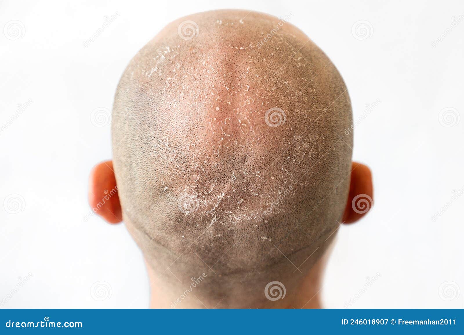 Male Bald Flaky Head with Dandruff Close-up, Back View. White Background  Stock Image - Image of itch, nape: 246018907