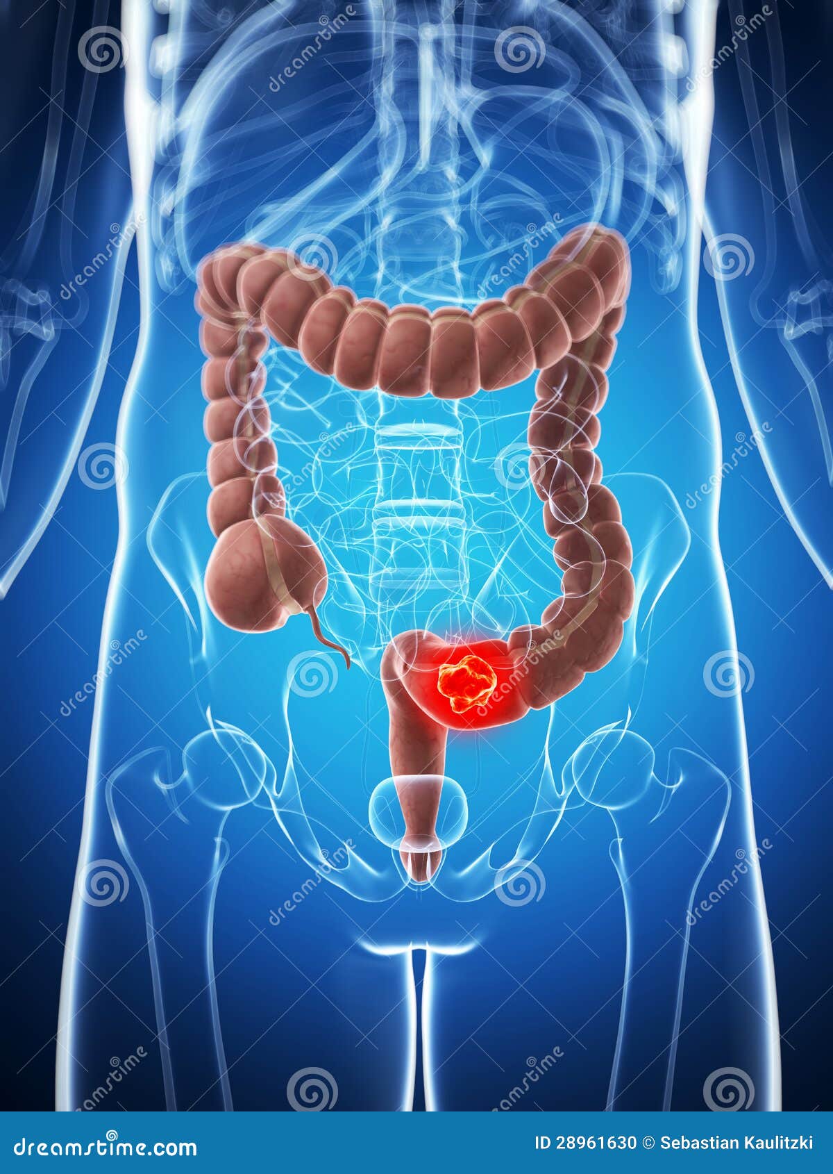 Male colon - cancer stock illustration. Illustration of highlight