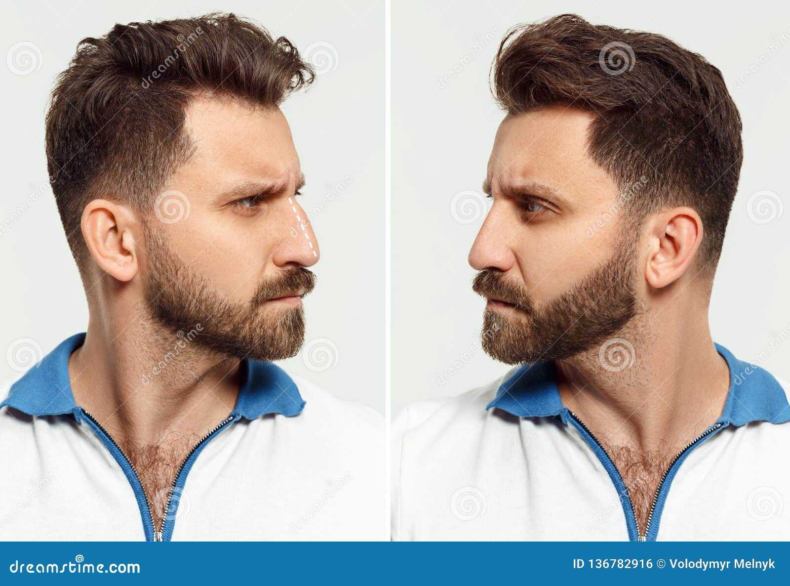 The Male Face before and after Cosmetic Nose Surgery. Over White Background  Stock Photo - Image of compare, medical: 136782916