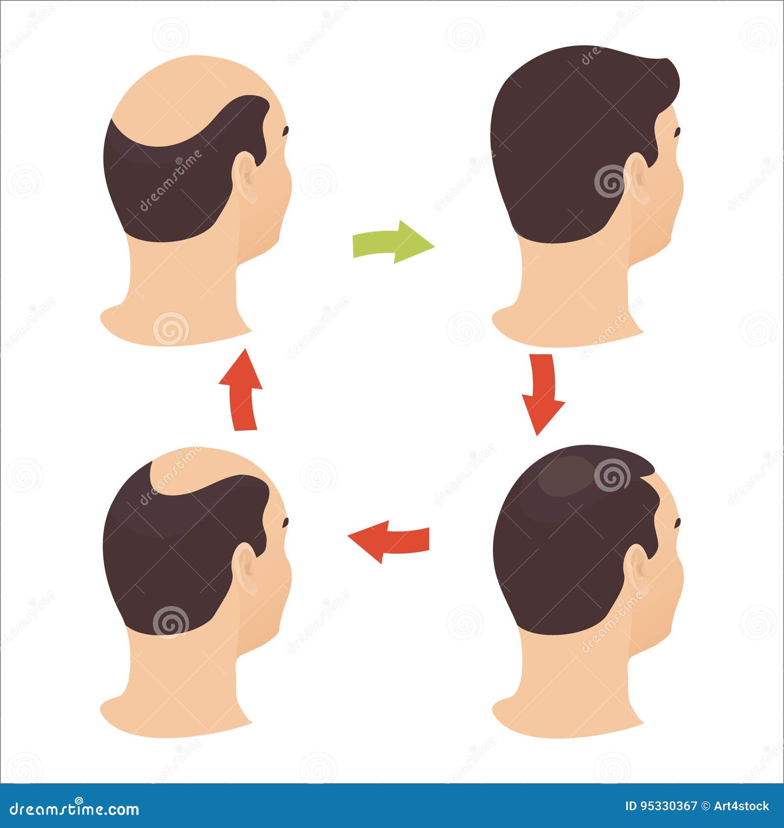 Male hair loss stages set stock vector. Illustration of aging - 95330367