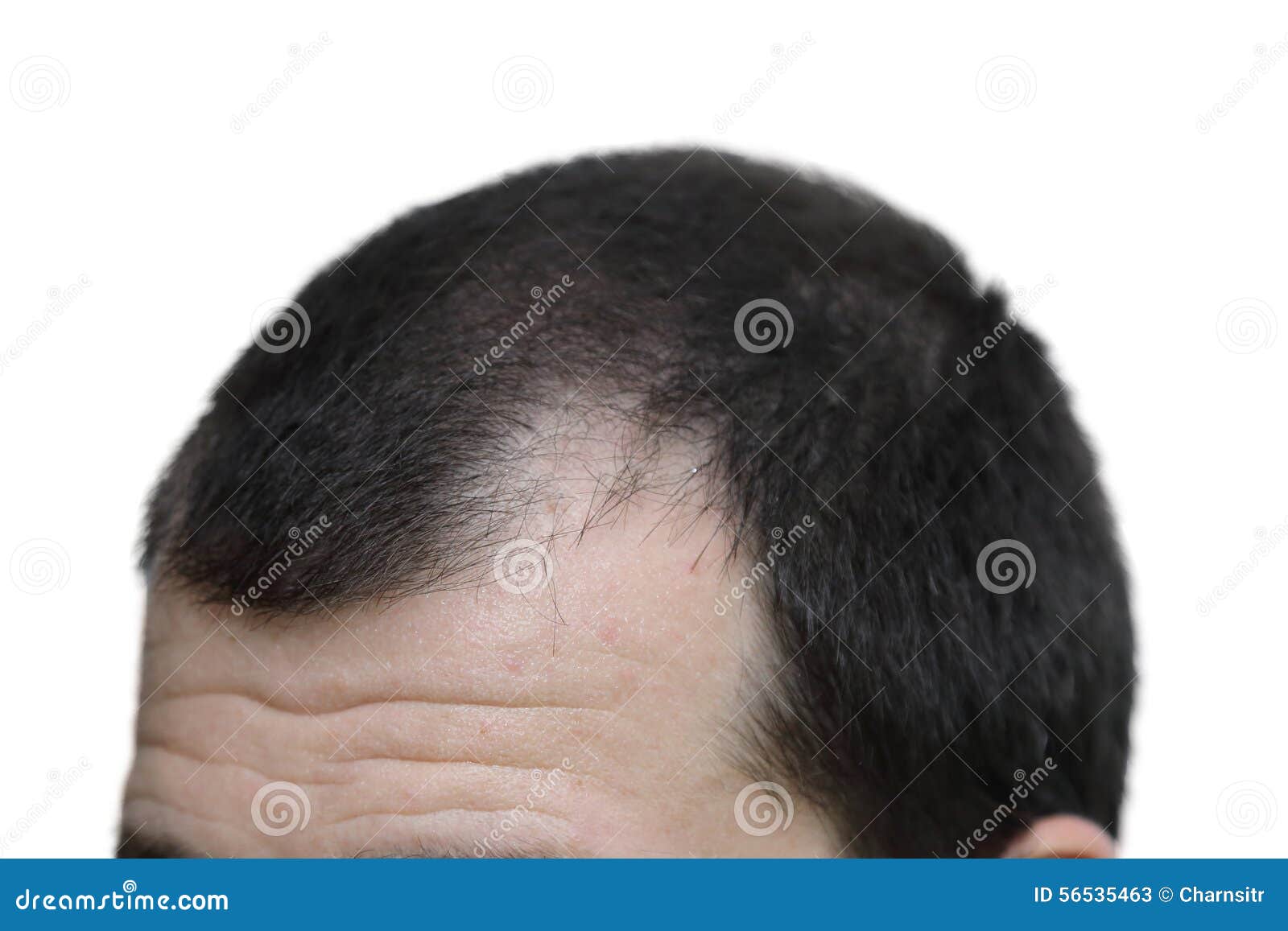 Male With Hair Loss Symptoms On White Background Stock Image