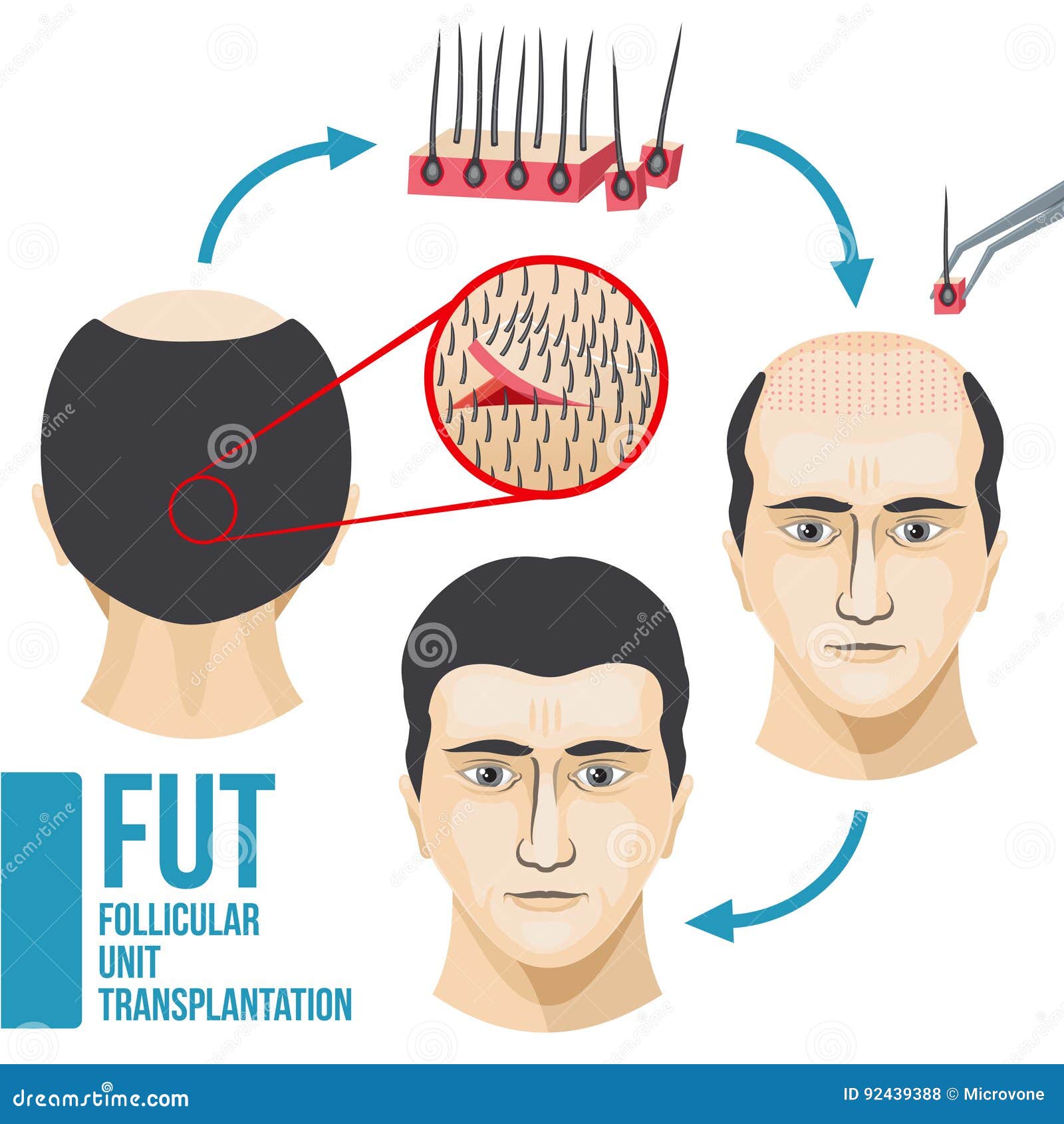 Stages Male Pattern Baldness Hair Loss Alopecia Asian Men Vector Stock