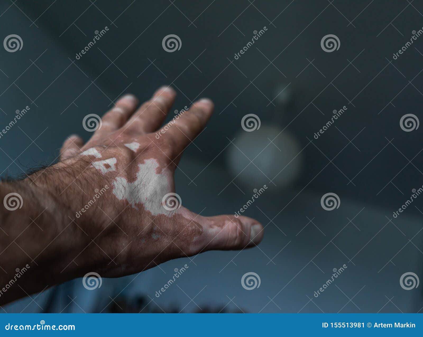 the male hand is affected by vitiligo. health.