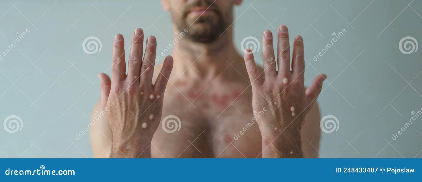 male hands affected by blistering rash because of monkeypox or other viral infection on white background
