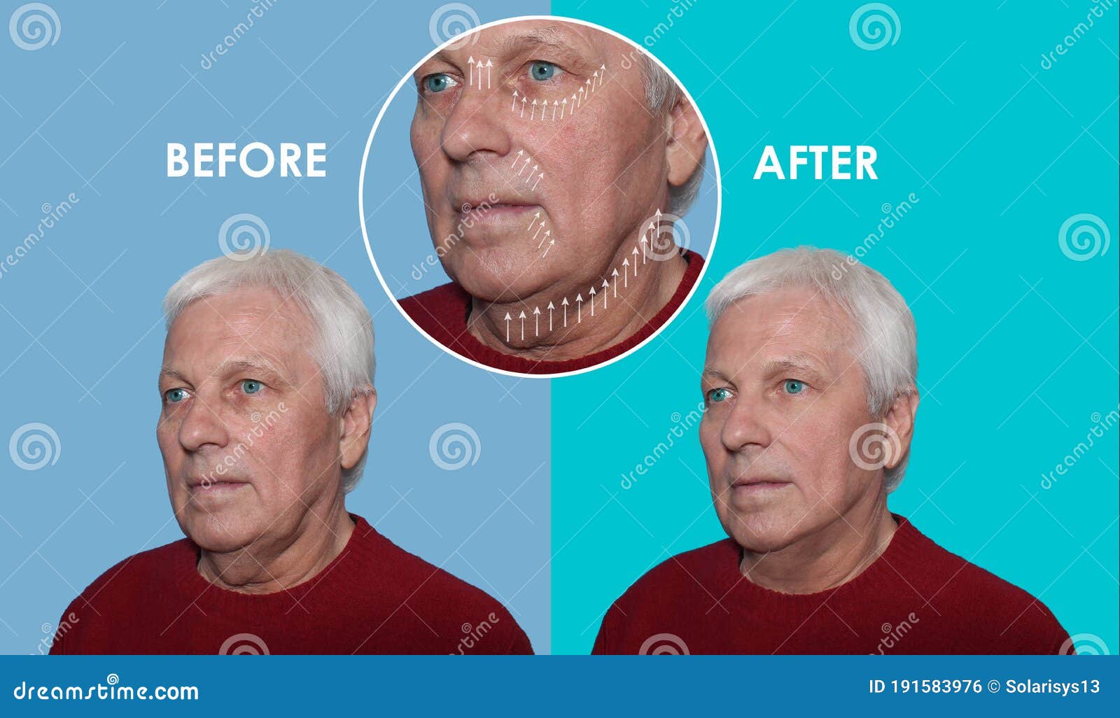 The Male Lifting before and after Procedures Stock Photo Image of