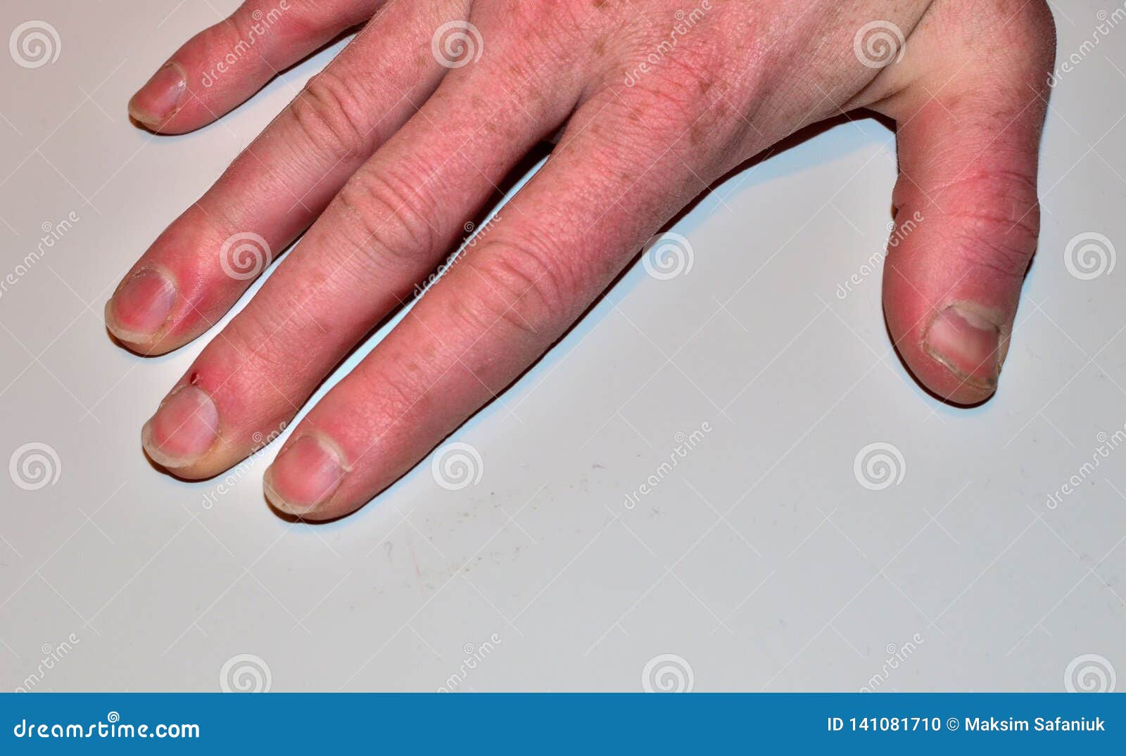 male nails disease fingernail lack nutrients do not make nail not shape not care health care concept male nails disease 141081710