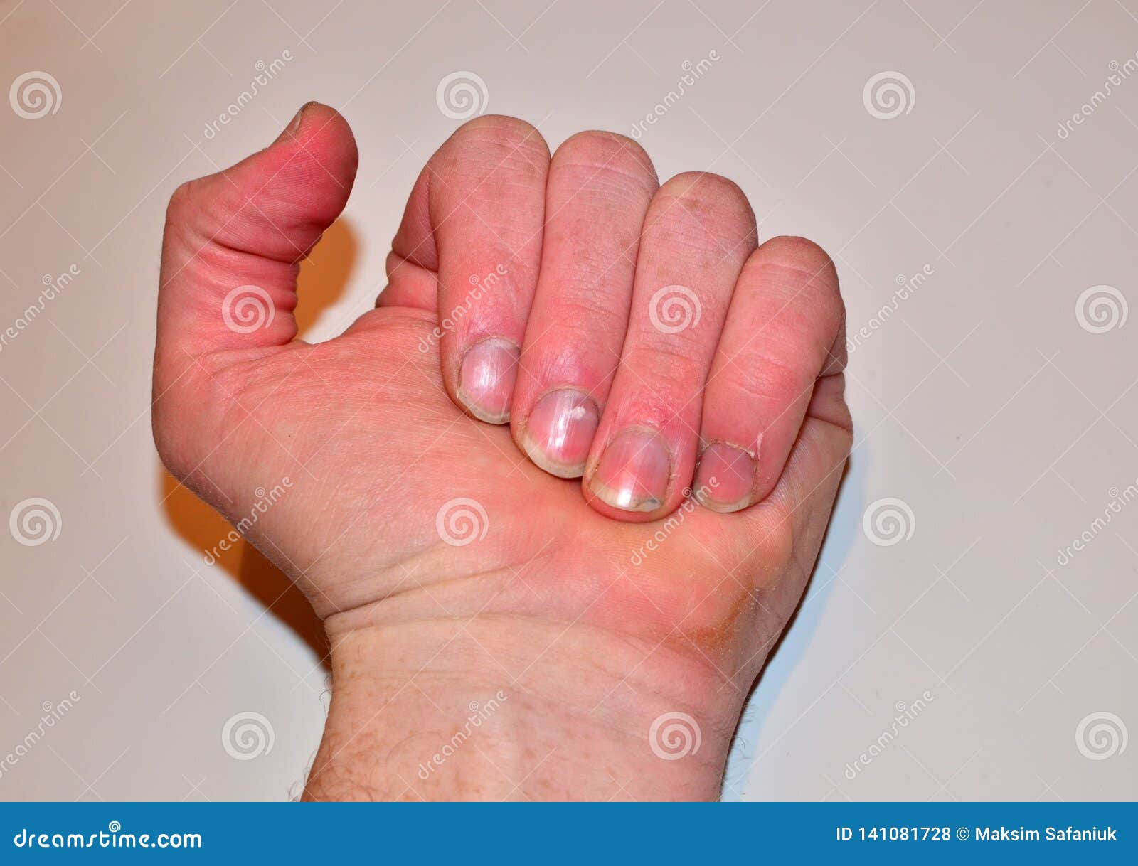male nails disease fingernail lack nutrients do not make nail not shape not care health care concept male nails disease 141081728