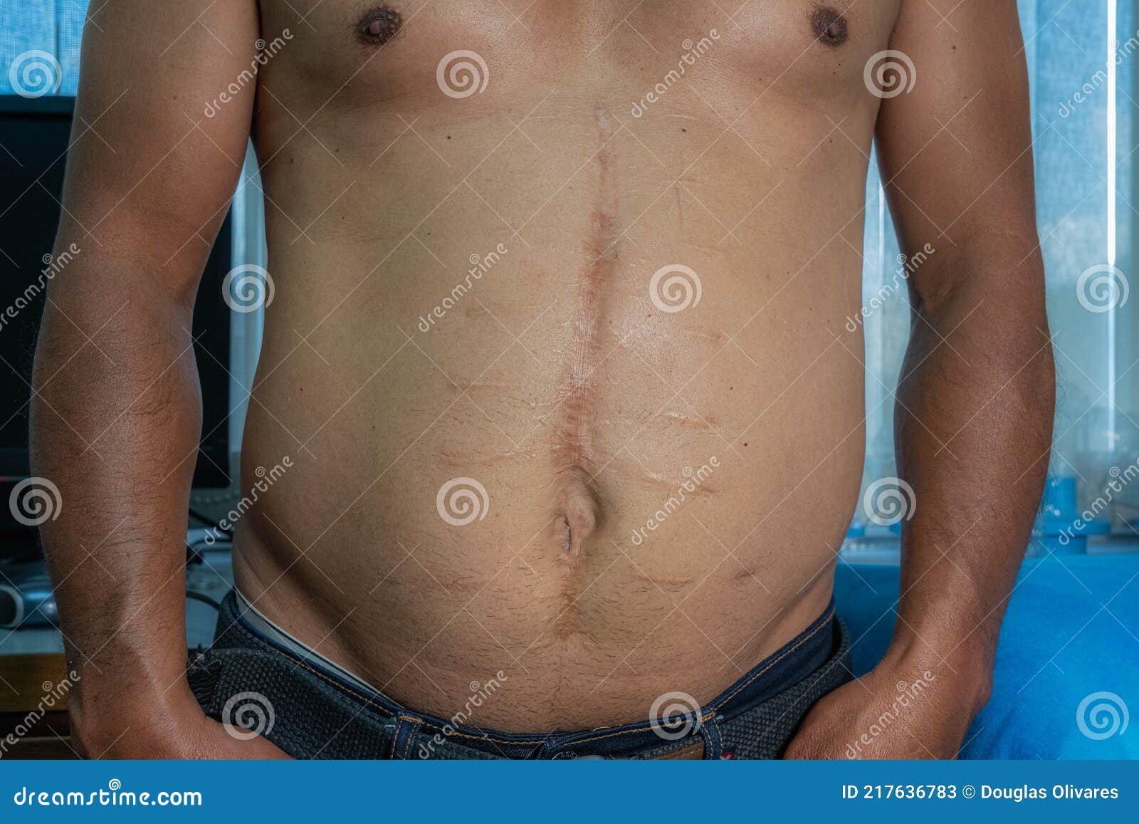 abdominal surgical incisions