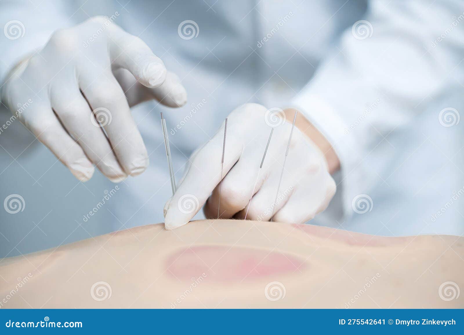 Male Patient Having a Session of Acupuncture in a Clinic Stock Image Image of caucasian